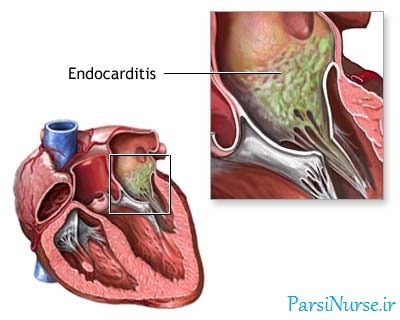 پروفیلاکسی اندوکاردیت چیست , پروفیلاکسی چیست , ایندوکاردیت 