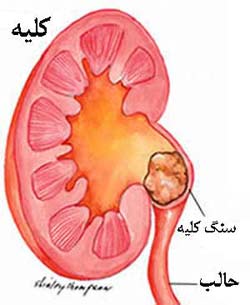 مقالات درباره سنگ کلیه , سنگ کلیه می تواند بدون علامت باشد تا زمانی که کلیه را از کار بیندازد. 