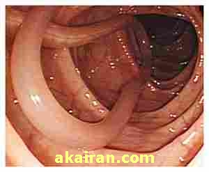 کرم روده , کرم در مدفوع , کرم روده انسان 
