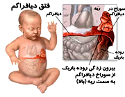 روش مناسب اکسیژن تراپی درفتق دیافراگمی 