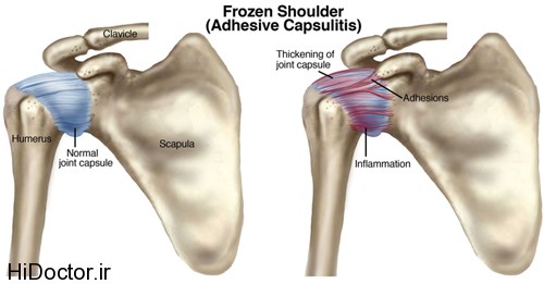 درمان پارگی رباط کروتا آکرومیال , شانه منجمد- درمان شانه منجمد- فیزیوتراپی شانه منجمد | دکتر وریانی م , bimarie cts 
