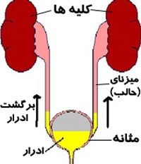 ریفلاکس ادراری, برگشت ادرار, درمان بیماری,مقالات پزشکی و بهداشتی،توصیه های پزشکی ، بهداشت