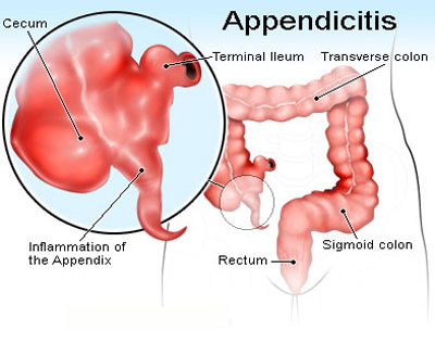 ,آپاندیس کجاست,علایم آپاندیس,درد آپاندیس,مقالات پزشکی و بهداشتی،توصیه های پزشکی ، بهداشت