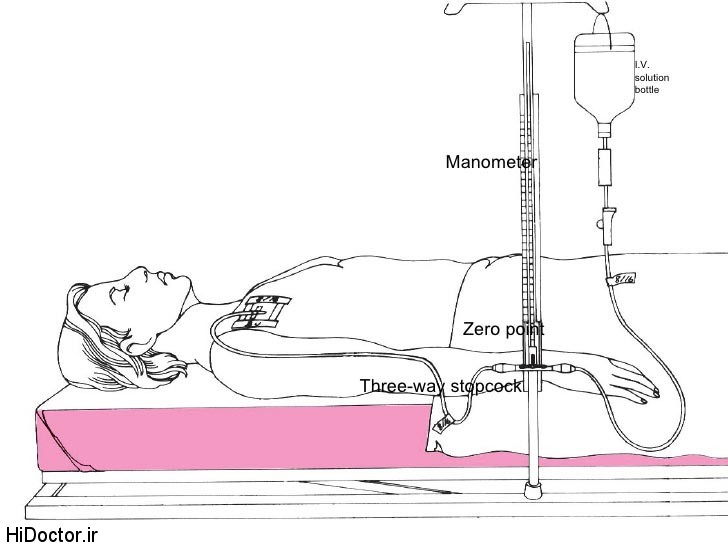 ,اندیکاسیون های تعبیه cv-line,محل های شایع استفاده شده جهت cv-line,علل شایع تغییر فشار ورید مرکزی,مقالات پزشکی و بهداشتی،توصیه های پزشکی ، بهداشت