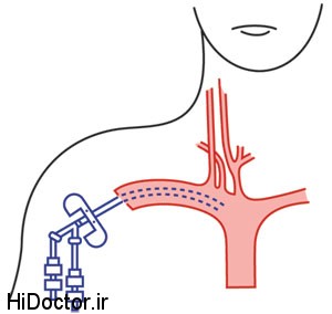 ,اندیکاسیون های تعبیه cv-line,محل های شایع استفاده شده جهت cv-line,علل شایع تغییر فشار ورید مرکزی,مقالات پزشکی و بهداشتی،توصیه های پزشکی ، بهداشت