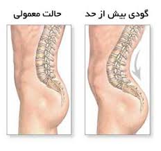 گودی کمر , علت گودی کمر چیست , علت گودی کمر 