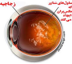 بیماری مگس پران چشم چه نوع بیماری است ؟ , مگس پران , علت مگسپران درچشم 