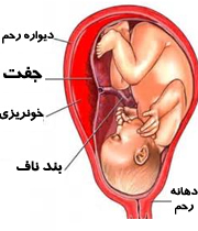 پاره شدن جفت جنین , سوراخ شدن جفت در بارداری 