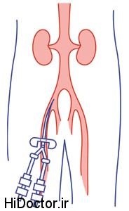 ,اندیکاسیون های تعبیه cv-line,محل های شایع استفاده شده جهت cv-line,علل شایع تغییر فشار ورید مرکزی,مقالات پزشکی و بهداشتی،توصیه های پزشکی ، بهداشت