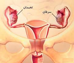 آندومتریوز چیست , علایم سرطان تخمدان در زنان , علایم سرطان تخمدان 