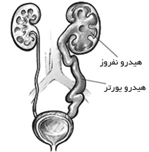 ریفلاکس ادراری, برگشت ادرار, درمان بیماری,مقالات پزشکی و بهداشتی،توصیه های پزشکی ، بهداشت