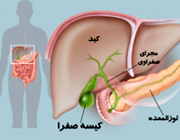 کیسه صفرا , سرطان کیسه صفرا , سرطان صفرا 