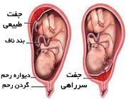 درمان جفت سر راهی , انواع مدل جفت در بارداری , انواع جفت سرراهی 