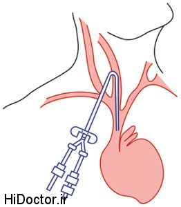 ,اندیکاسیون های تعبیه cv-line,محل های شایع استفاده شده جهت cv-line,علل شایع تغییر فشار ورید مرکزی,مقالات پزشکی و بهداشتی،توصیه های پزشکی ، بهداشت