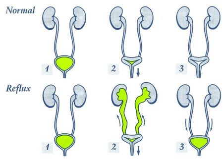 ریفلاکس ادراری, برگشت ادرار, درمان بیماری,مقالات پزشکی و بهداشتی،توصیه های پزشکی ، بهداشت